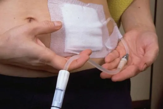 Dialise Peritoneal na IRA: quando ela salva o jogo