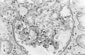 Recorrência de GESF após transplante renal: devo indicar tratamento profilático?