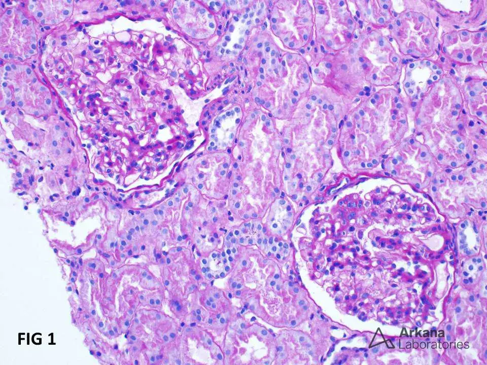 Corticoide na Nefropatia por IgA segundo o KDIGO 2025